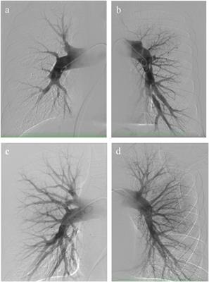 Surgical treatment of chronic thromboembolic pulmonary hypertension in combination with a left anterior descending artery myocardial bridge: A case report